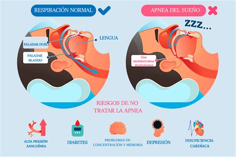 mientras papi duerme 4 pag 11|APNEA DEL SUEÑO.